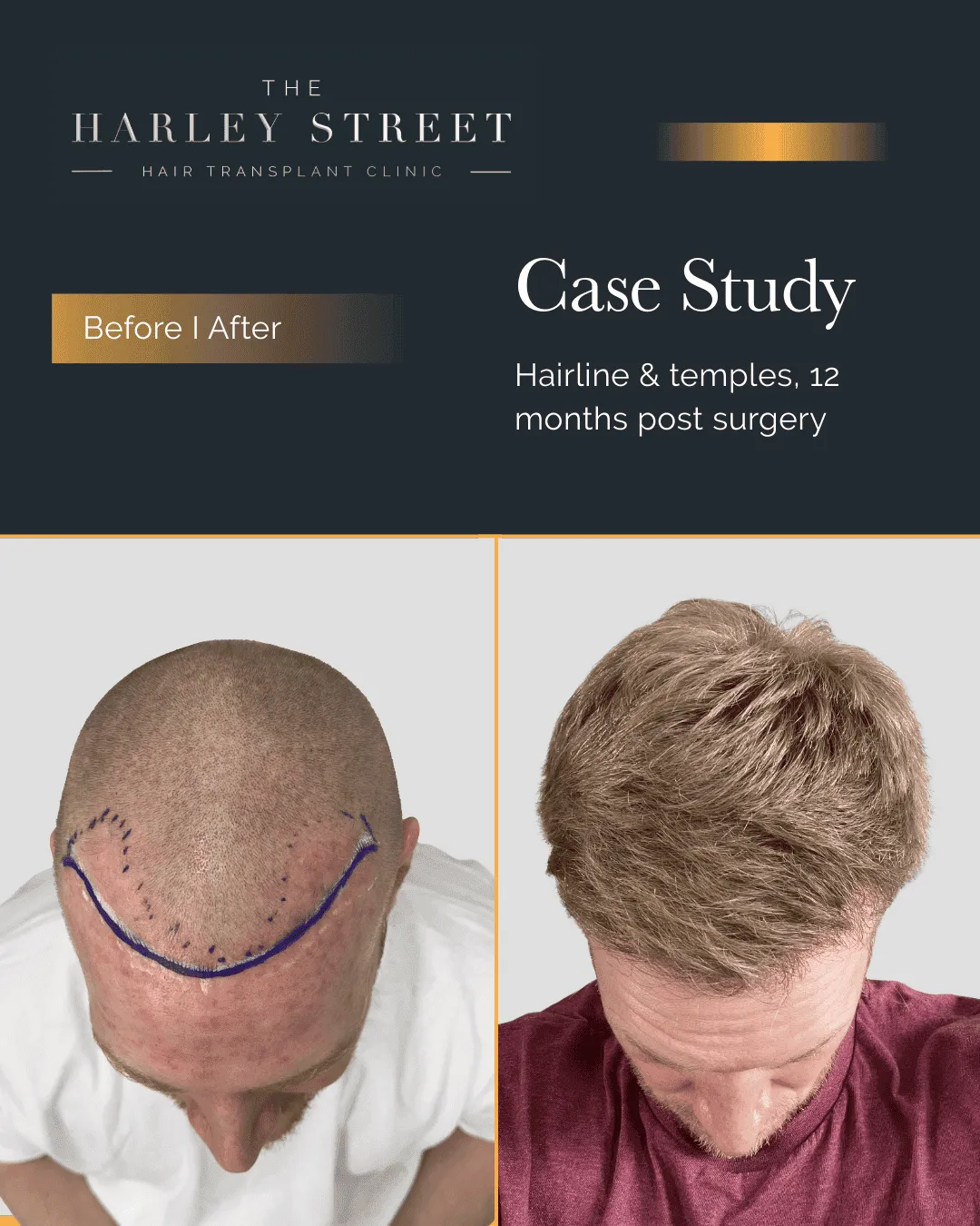 Widow's Peak Hair Transplant Harley Street HT pt Kirkpatrick hairline aerial