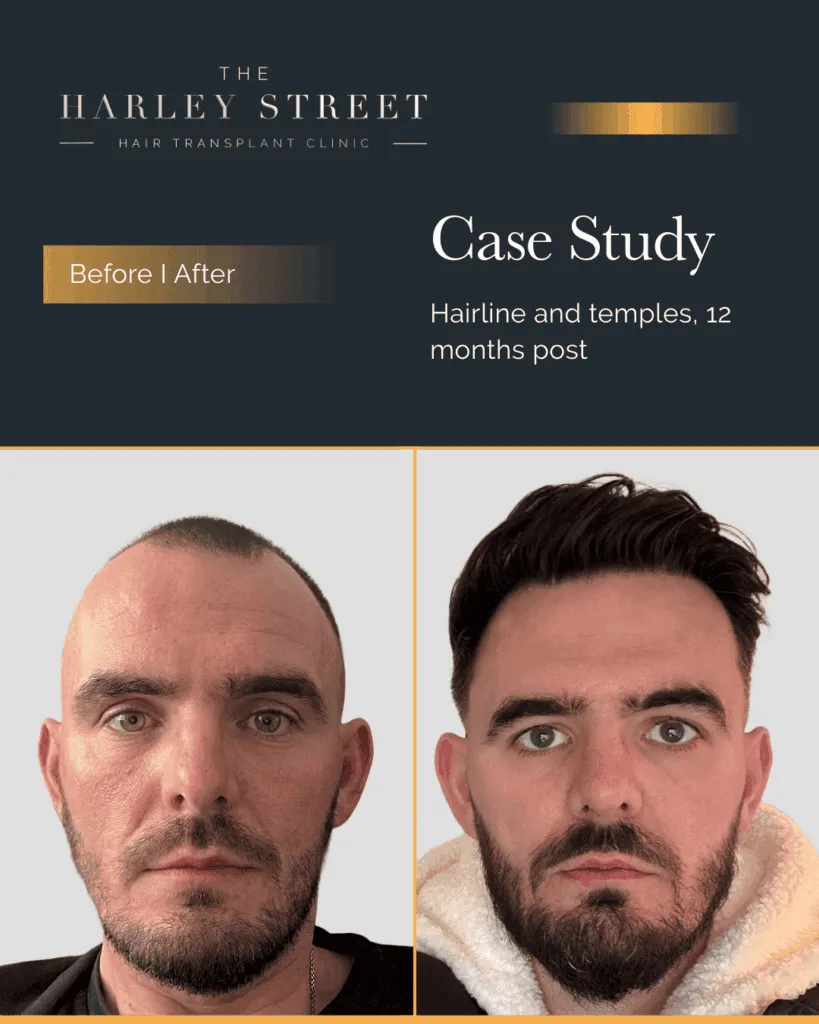 Hair Transplant Aftercare Harley Street HT pt Ryan frontal 3rd hairline