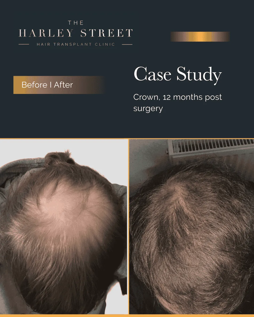 Crown Hair Transplant Harley Street HT pt, Wagstaff, crown