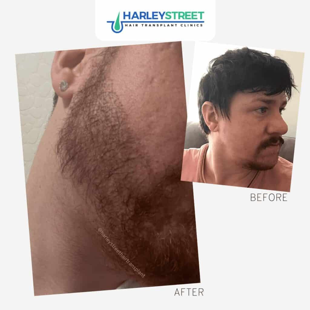 Beard Transplant in Manchester Harley Street Hair Transplant Clinics beard transplant patient before and after