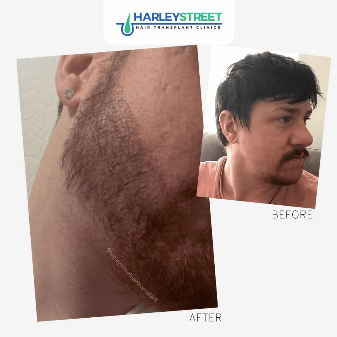 Beard Transplant Harley Street Hair Transplant Clinics beard transplant patient before and after