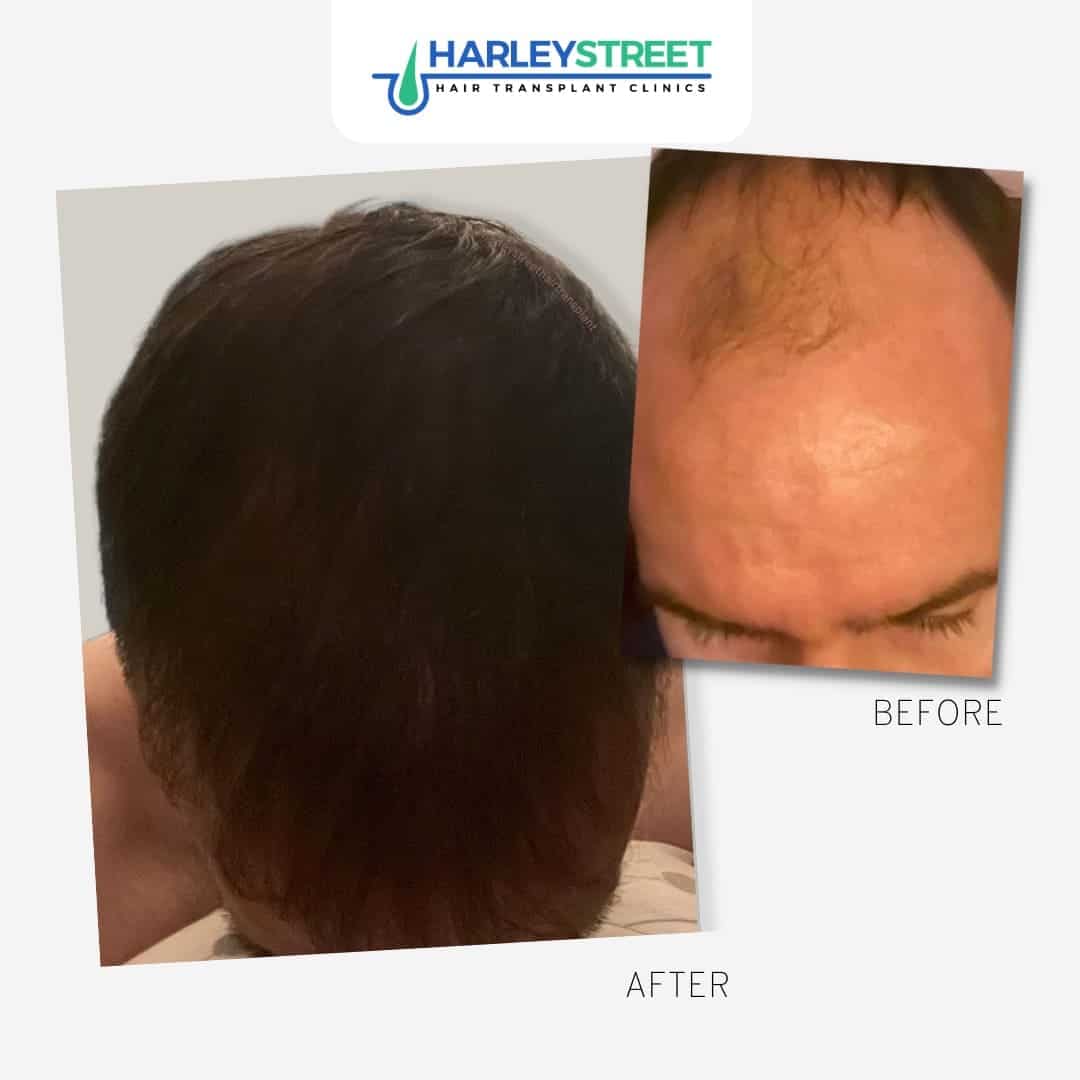 Hair Transplant Before and After Results Harley Street before and after tom