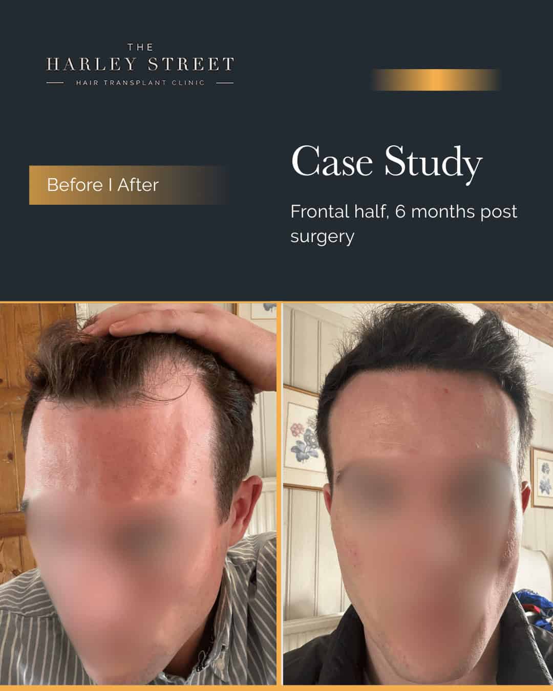 Temple Hair Transplant Harley Street pt Finney hairline