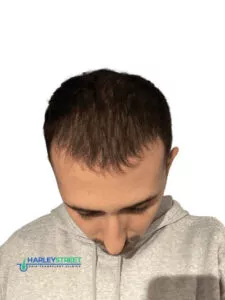 How Long Does a Hair Transplant Take to Heal? Ilir 3 months post ht