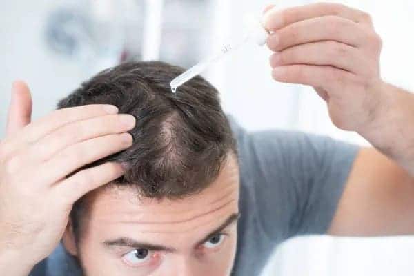 PRP vs Topical Finasteride and Minoxidil Combo Man applying topical finasteride and minoxidil combo