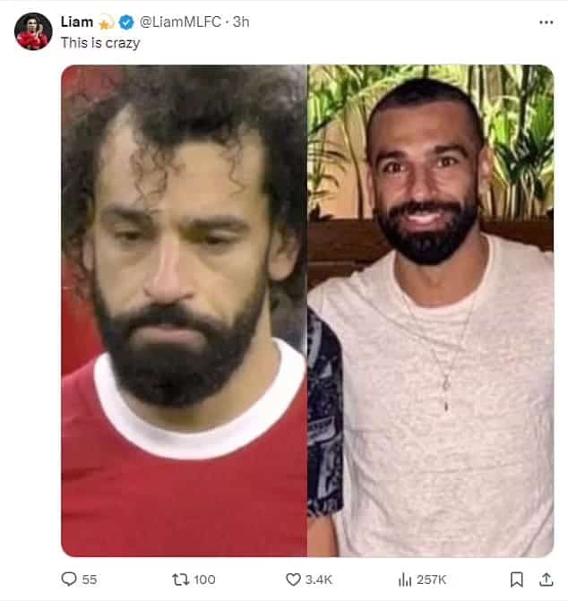 Mo Salah Hair Transplant Mo Salah before and after hair transplant