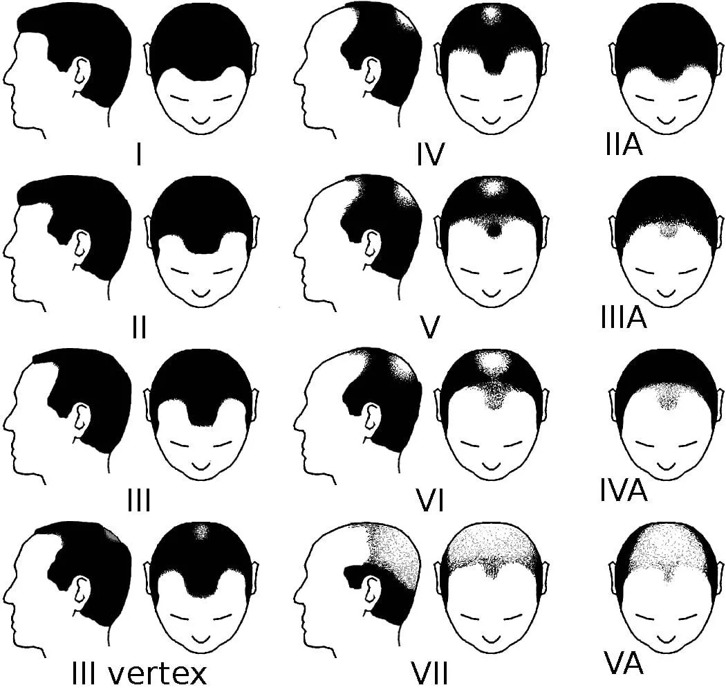 The Norwood Scale 2 Norwood scale for male pattern baldness
