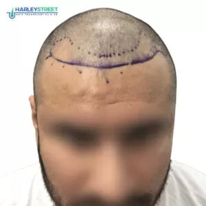 Hairline Hair Transplant Shreyas Malhotra Pre surgery