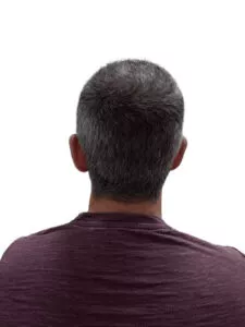 Hair Transplant Timeline Thomas 6 months post crown ht