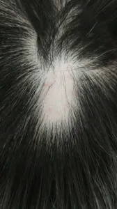 Alopecia alopecia areata