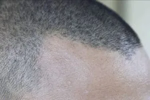 Alopecia androgenetic alopecia