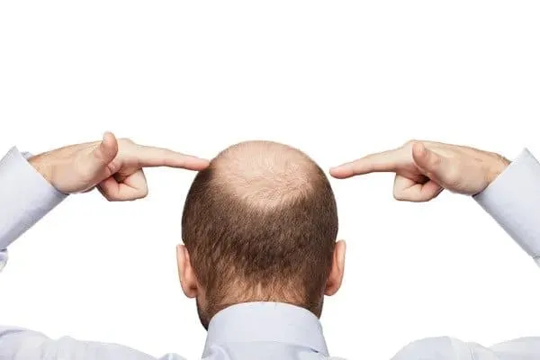 Is There a Cure For Baldness? bald man looking for a cure