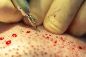 Body Hair Transplants body hair extraction