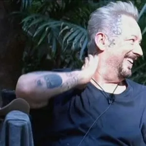 Boy George Hair Transplant boy george after a hair transplant