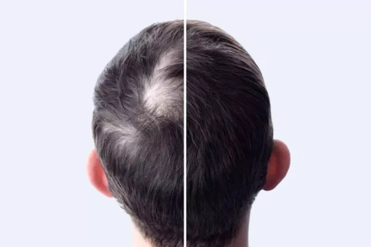 Crown Hair Transplant crown hair transplant