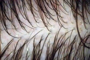 Does Dandruff Cause Hair Loss? dandruff and hair loss