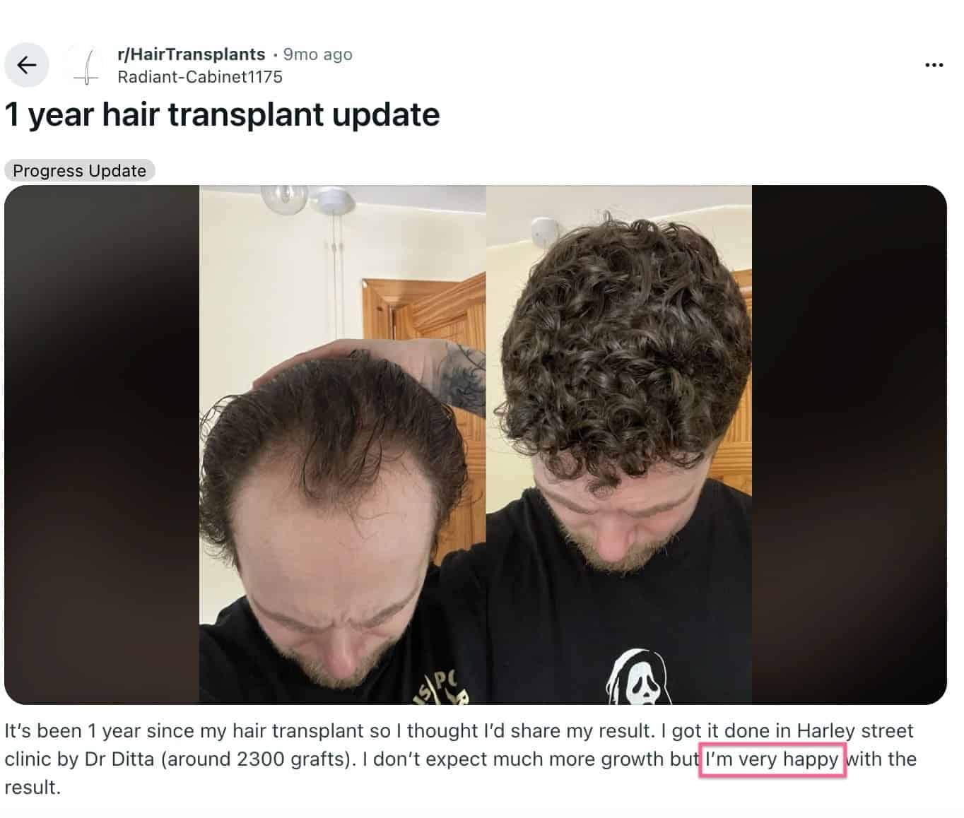 Hair Transplant Reviews declan reddit ht results