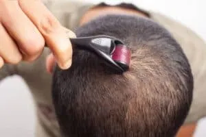 Does Using a Dermaroller For Hair Growth Work? dermaroller for crown hair growth