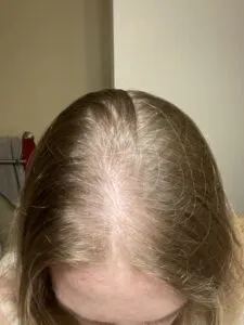 Diffuse Hair Loss diffuse hair loss patient 2