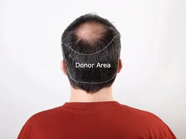 Donor Area for Hair Transplant donor area for hair transplant