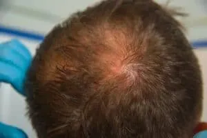 How to Spot and Stop Balding on Crown early detection of a thinning crown