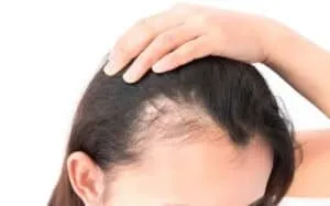 Spironolactone For Hair Loss female hair loss on the temples