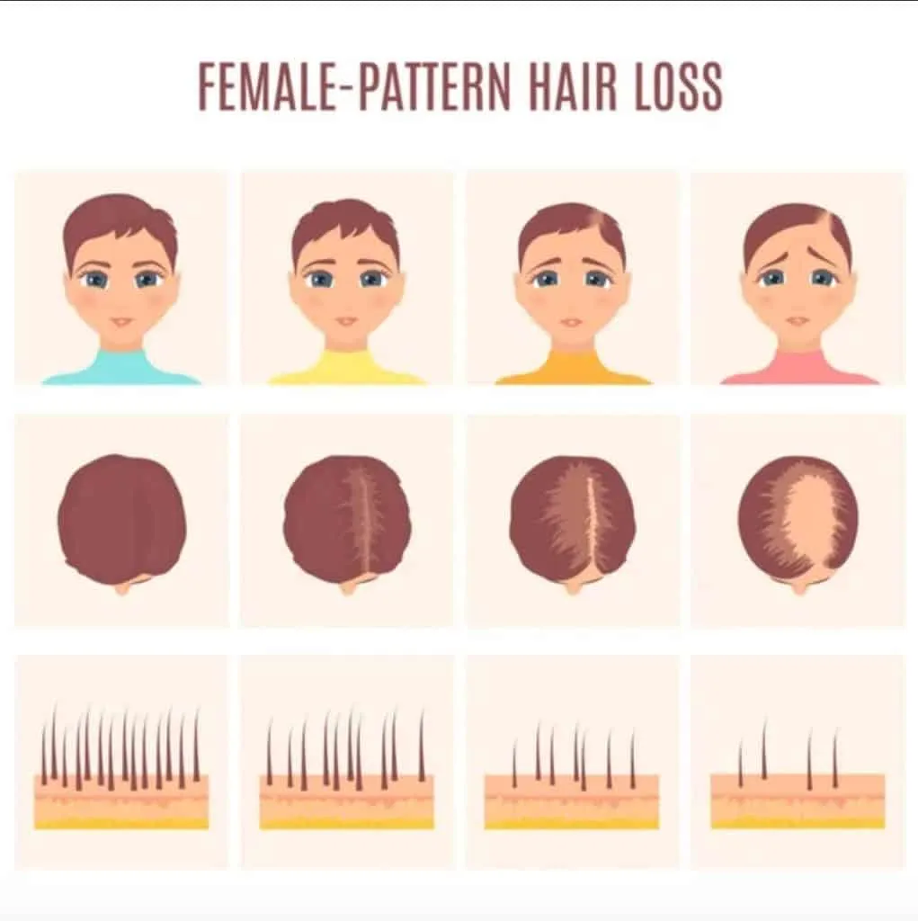 Female Pattern Baldness female pattern hair loss