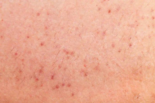 Folliculitis After Hair Transplant folliculitis on human skin