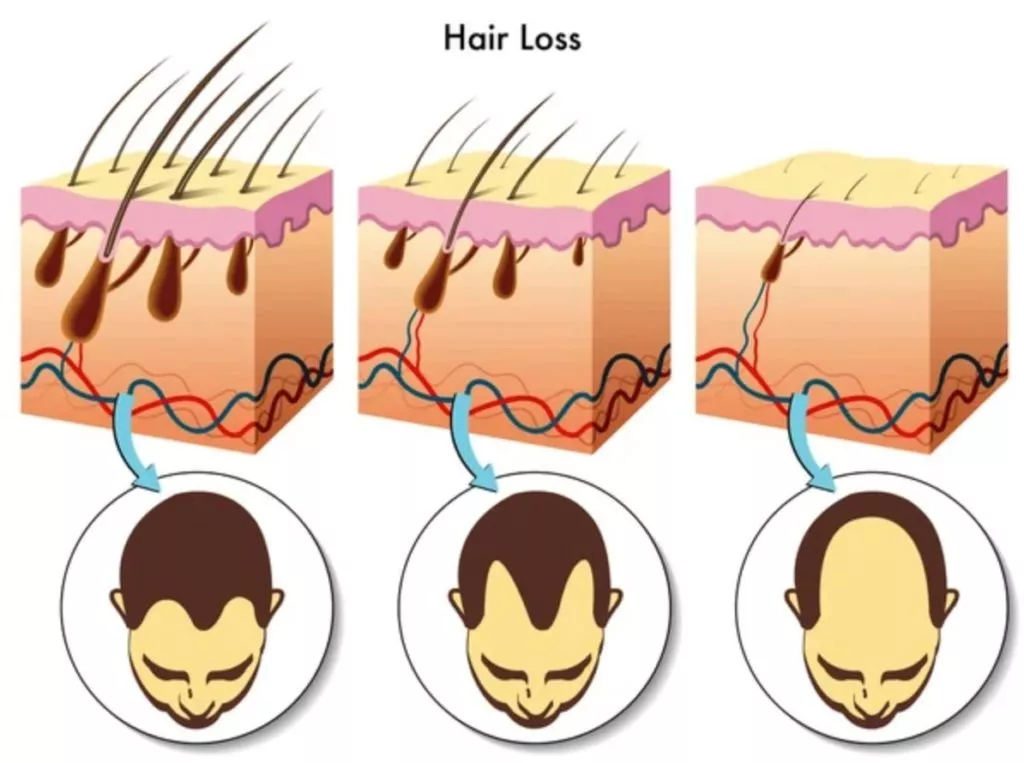 Hair Loss hair loss stages