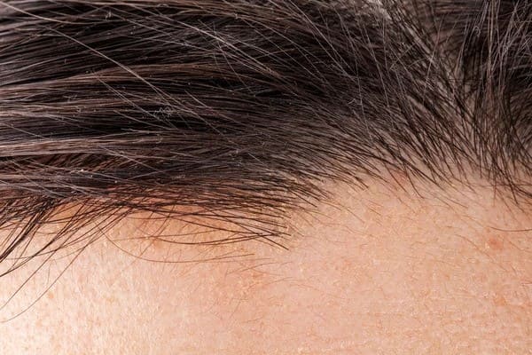 Hair Transplant Repair hair transplant repair close up