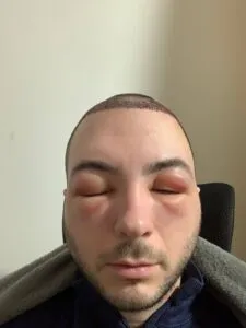Hair Transplant Swelling hair transplant swelling