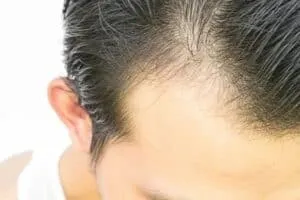 Can Vitamin B12 Deficiency Cause Hair Loss? hairloss due to vitamin b12 deficiency