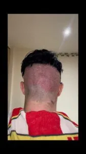 Hair Transplant Holes and Trypophobia harley street patient 3
