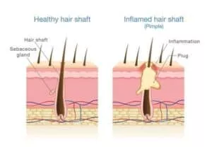 Folliculitis After Hair Transplant infected hair follicle