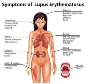 Illnesses That Cause Hair Loss in Women lupus and hair loss in women
