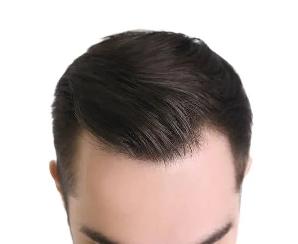 M Shaped Hairline m shaped hairline on man