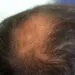 Does Alphainfuse Work For Hair Loss? male crown hair loss