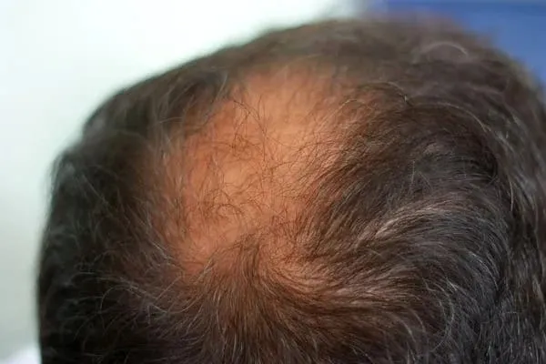 Does Alphainfuse Work For Hair Loss? male crown hair loss