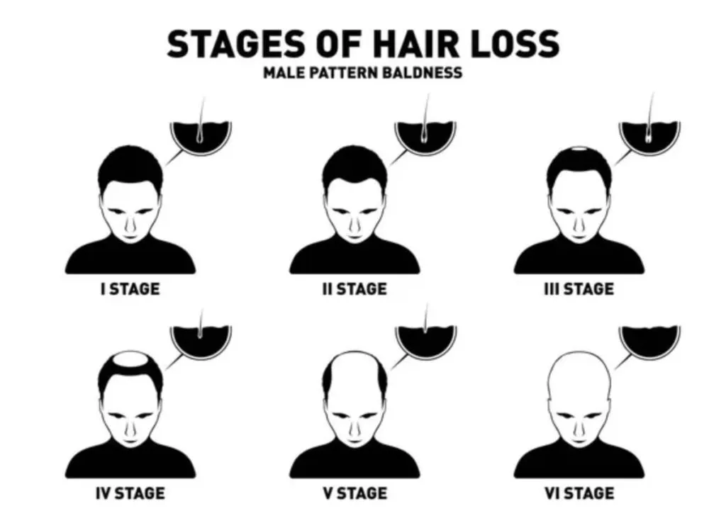 M Shaped Hairline male pattern baldness