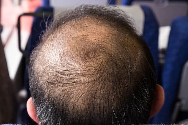 How to Spot and Stop Balding on Crown man balding on crown