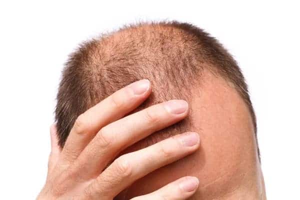 Why Do Men Go Bald and Women Don't? man suffering with hair loss