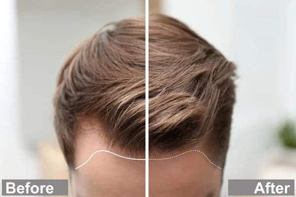 Mature Hairline - All You Need to Know mature vs receding hairline