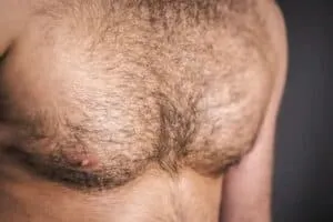Body Hair Transplants men's chest hair