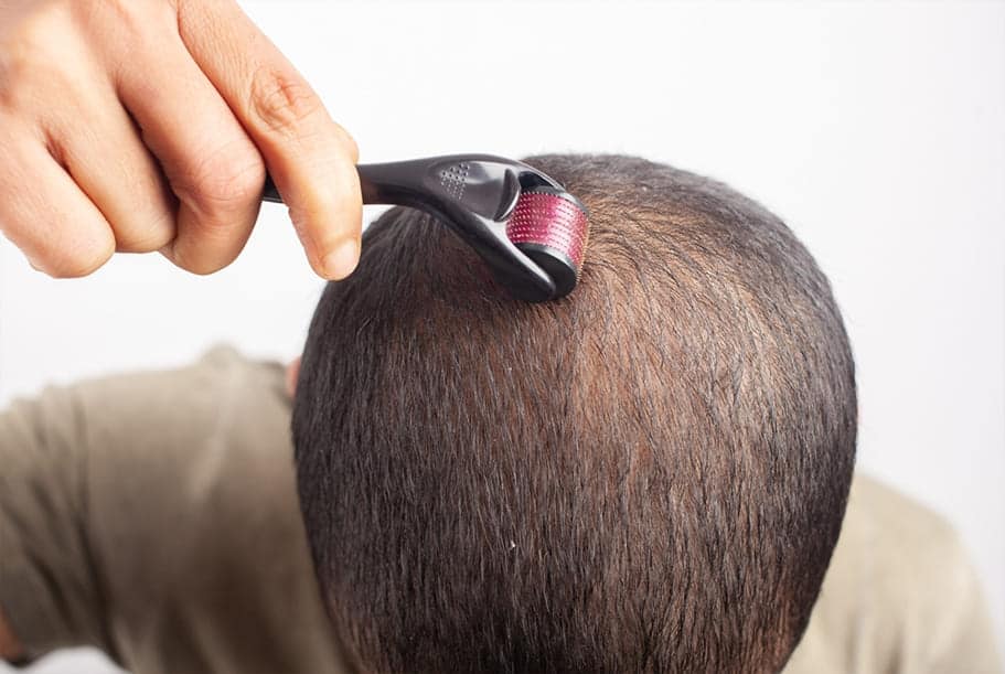 Microneedling For Hair Loss: Does It Actually Work? microneedling for hair loss