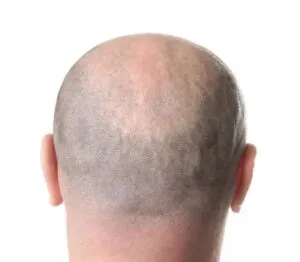 Body Hair Transplants not enough scalp donor area