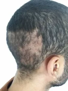 What is An Overharvested Donor Area overharvested donor are 1