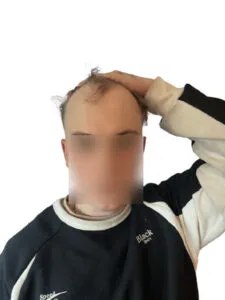 Hairline Hair Transplant Cost patient with receding hairline removebg preview