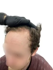 The Recipient Area Explained recipient area for a hair transplant