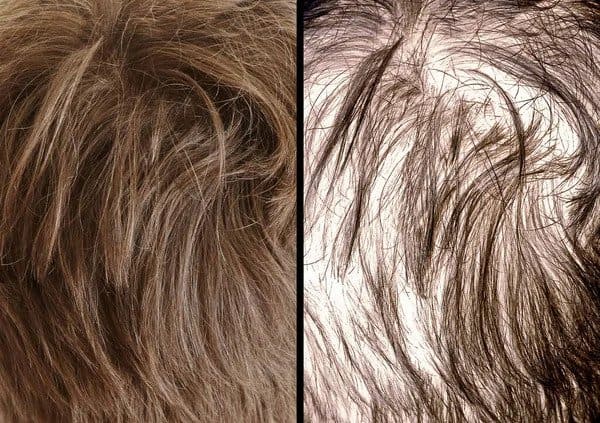 Retrograde Alopecia retrograde alopecia donor hair thinning
