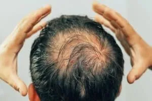 How to Spot and Stop Balding on Crown signs of thinning on the crown